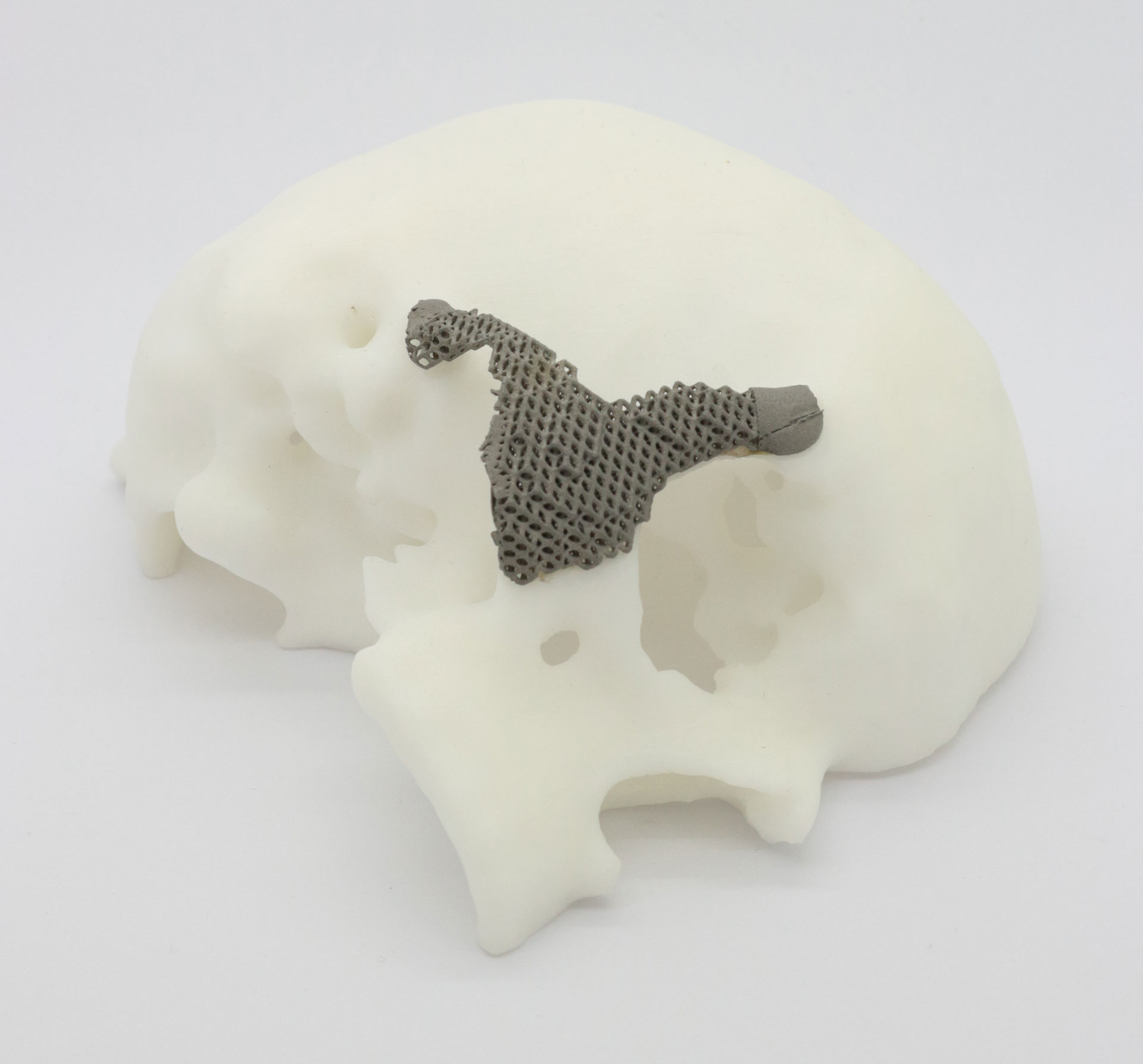 Modell des menschlichen Schädels mit additiv gefertigtem Implantat des Joch- und Teil des Schläfenbeins